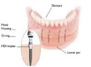 denture